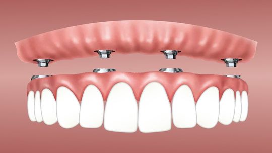 Obiecali uniwersalną protezę zębową. Przysłali zabawkowe zęby